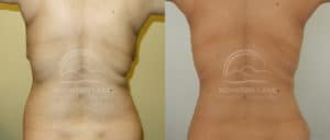 before and after liposuction