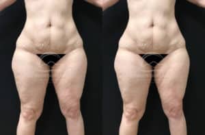 before and after liposuction