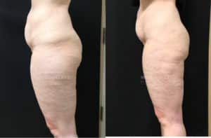 before and after liposuction