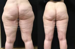 before and after liposuction