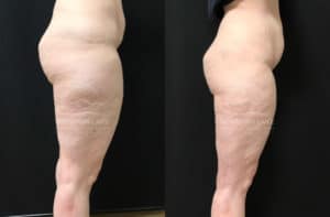 before and after liposuction