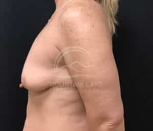 before mastopexy breast lift