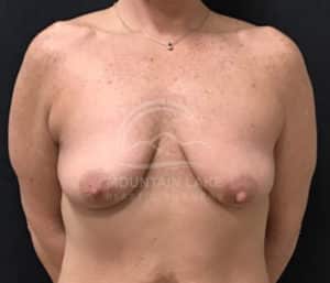 before mastopexy breast lift