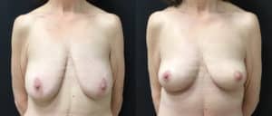 before and after mastopexy breast lift