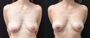 before and after mastopexy breast lift