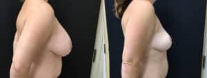 before and after mastopexy breast lift