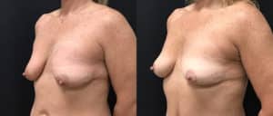 before and after mastopexy breast lift