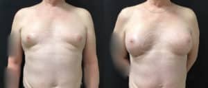 before and after mtf top surgery