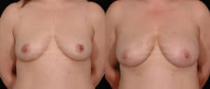 before and after natural breast augmentation