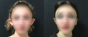 before and after otoplasty ear surgery