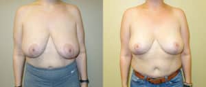 before and after repeat breast reduction