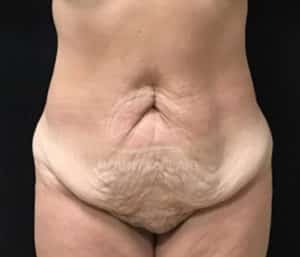 before tummy tuck