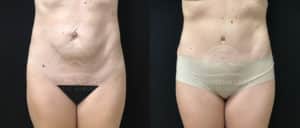 before and after tummy tuck