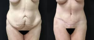 before and after tummy tuck