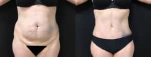 before and after tummy tuck