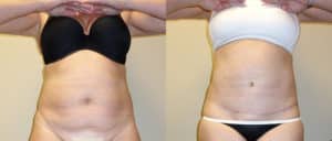 before and after tummy tuck