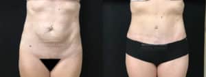 before and after tummy tuck
