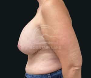 before implant removal
