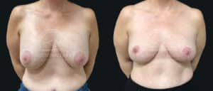before and after implant removal