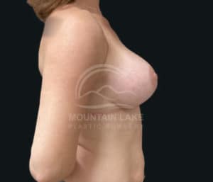 after breast lift with implants