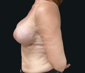 after breast lift with implants