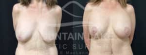 before and after breast lift with implants