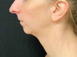 before chin liposuction