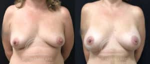 before and after breast augmentation