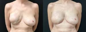 before and after breast reconstruction