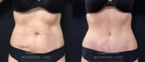 before and after tummy tuck