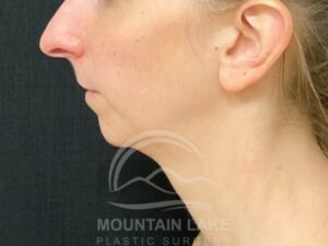 before chin implants
