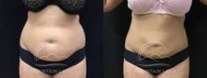 before and after liposuction