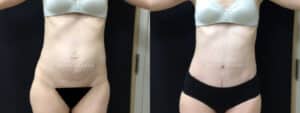 before and after tummy tuck