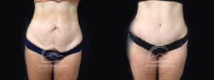 before and after body contouring after weight loss