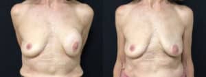 before and after implant removal