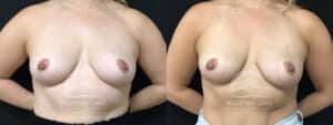 before and after inverted nipple correction