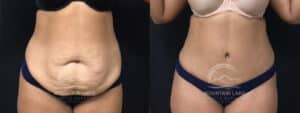 before and after tummy tuck