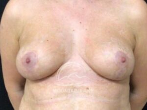 after mastopexy breast lift