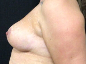 after mastopexy breast lift