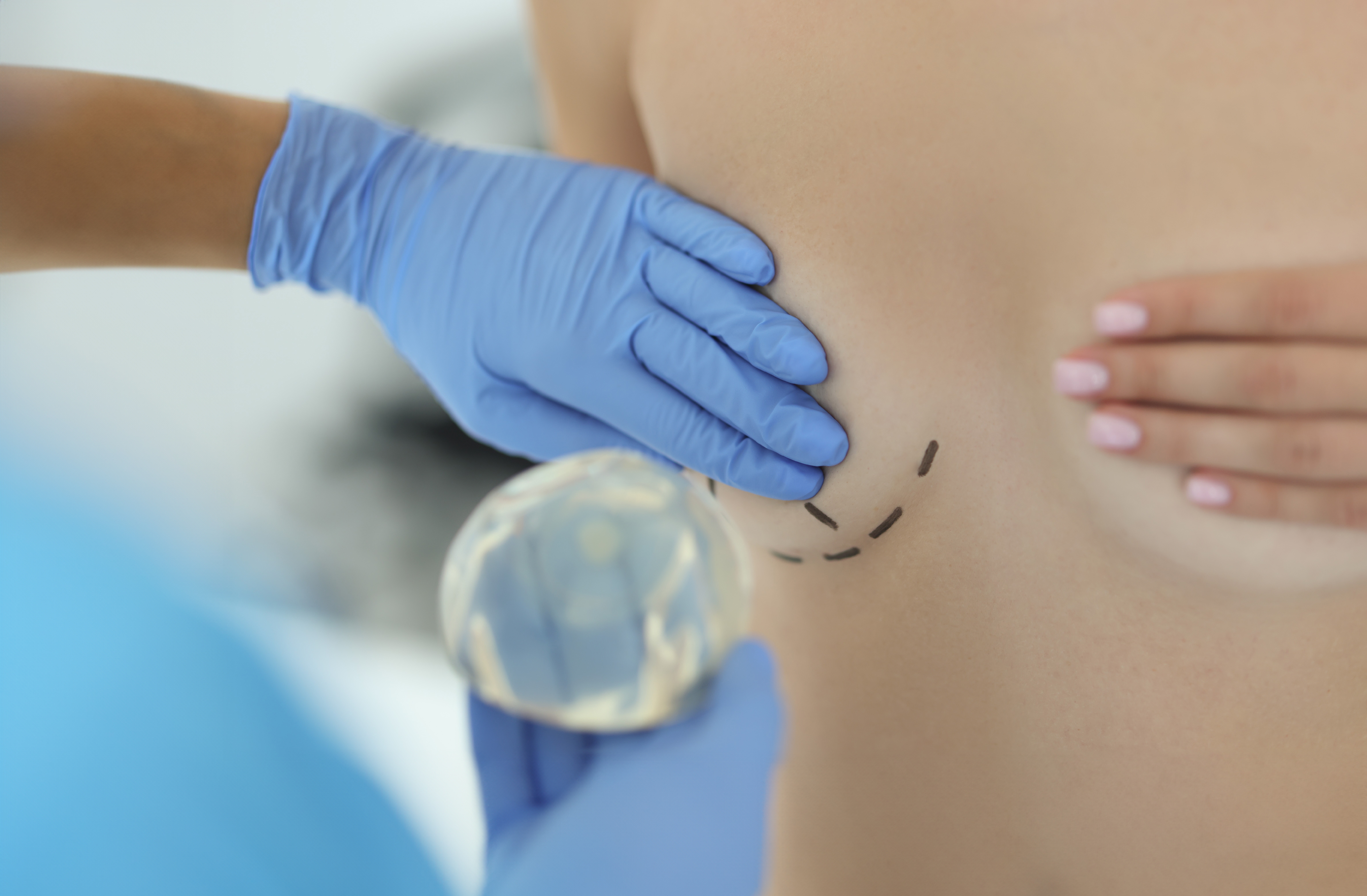 Plastic surgeon removing breast implants from patient.